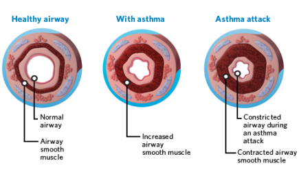 airways_asthma1